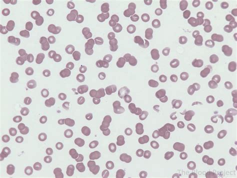 rouleaux formation blood test results.